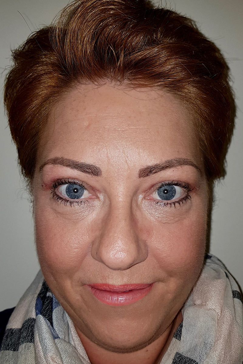 Blepharoplasty Post-op