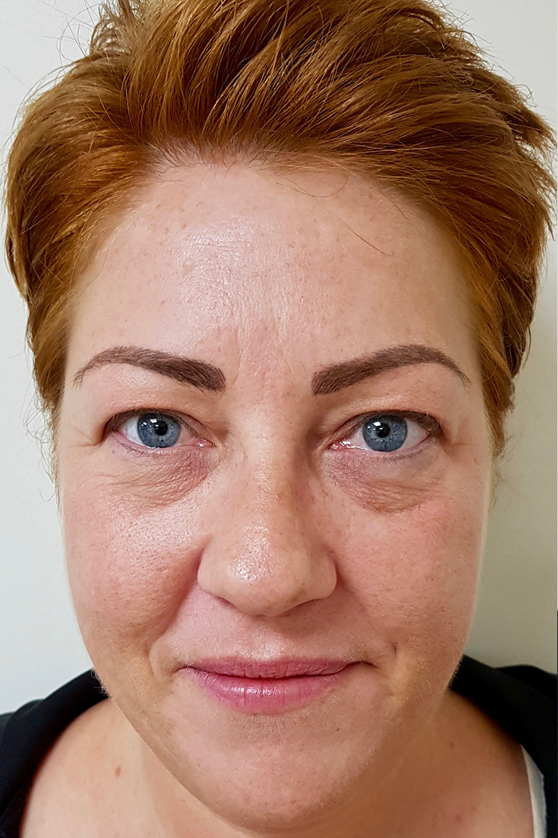 Blepharoplasty Pre-op