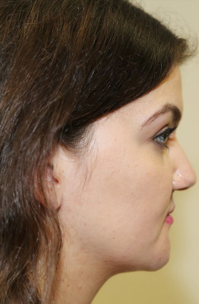 Chin Reduction Post-op