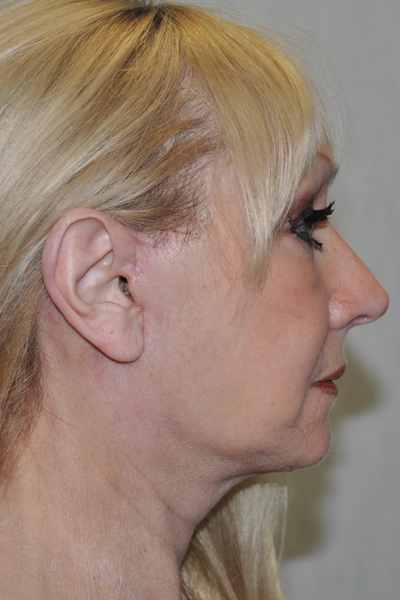 Facelift Post-op