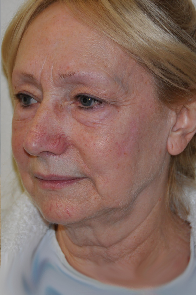 Facelift Pre-op