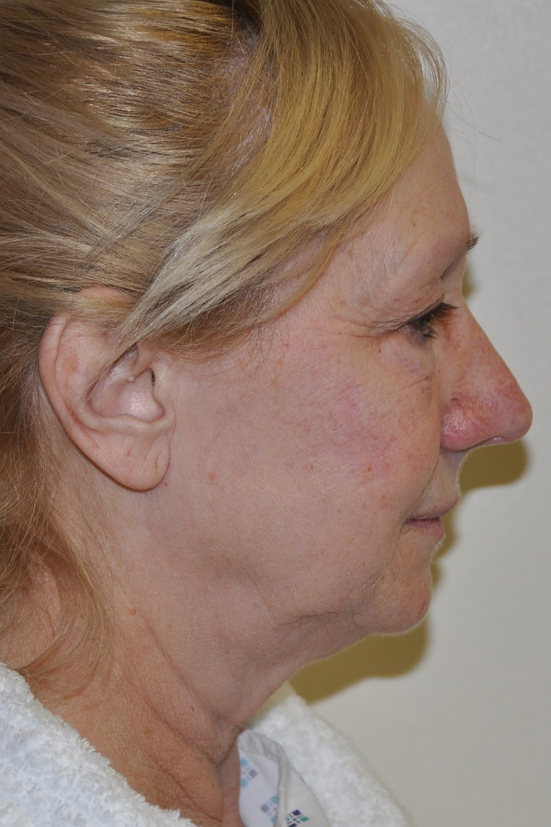 Facelift Pre-op