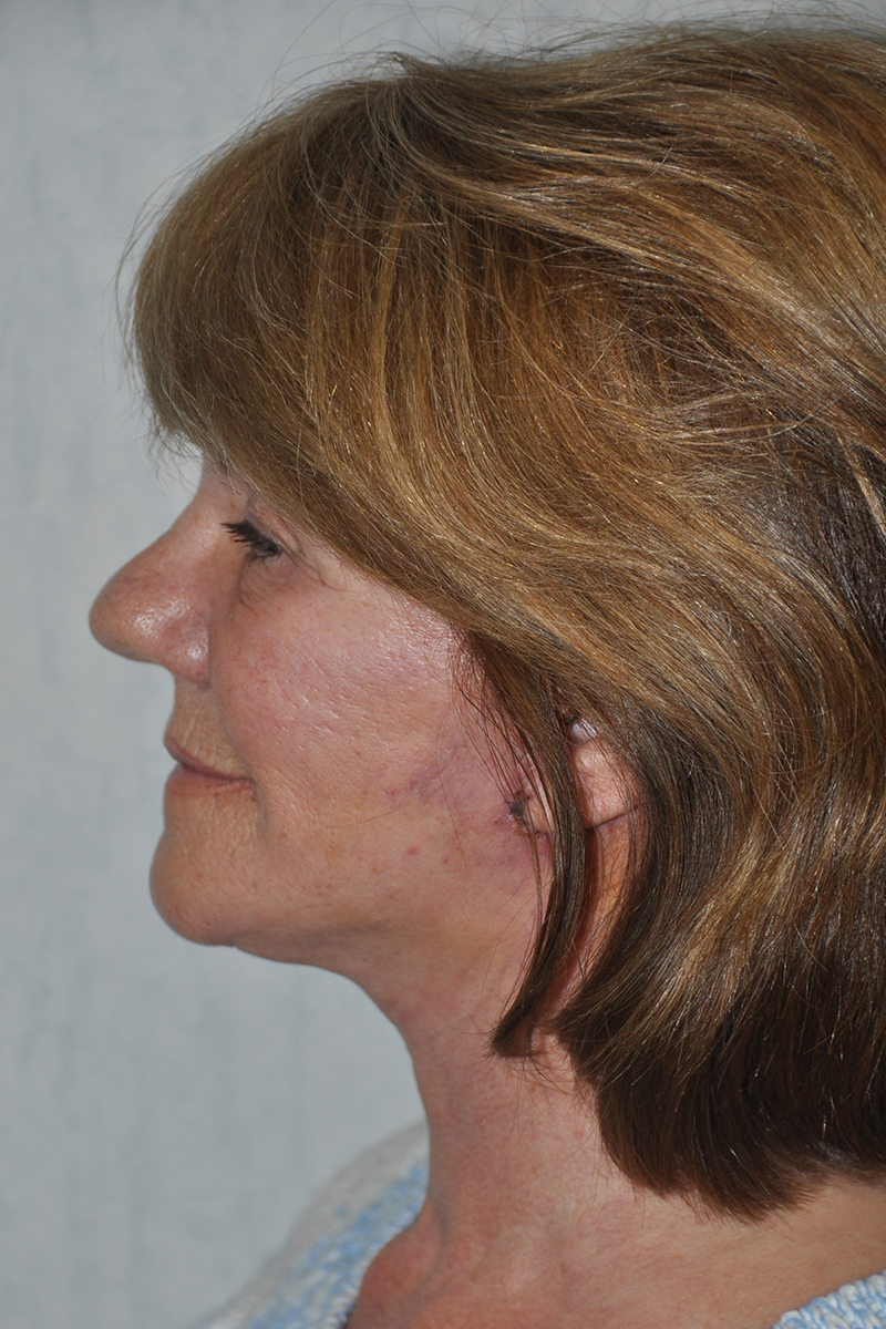 Facelift Post-op