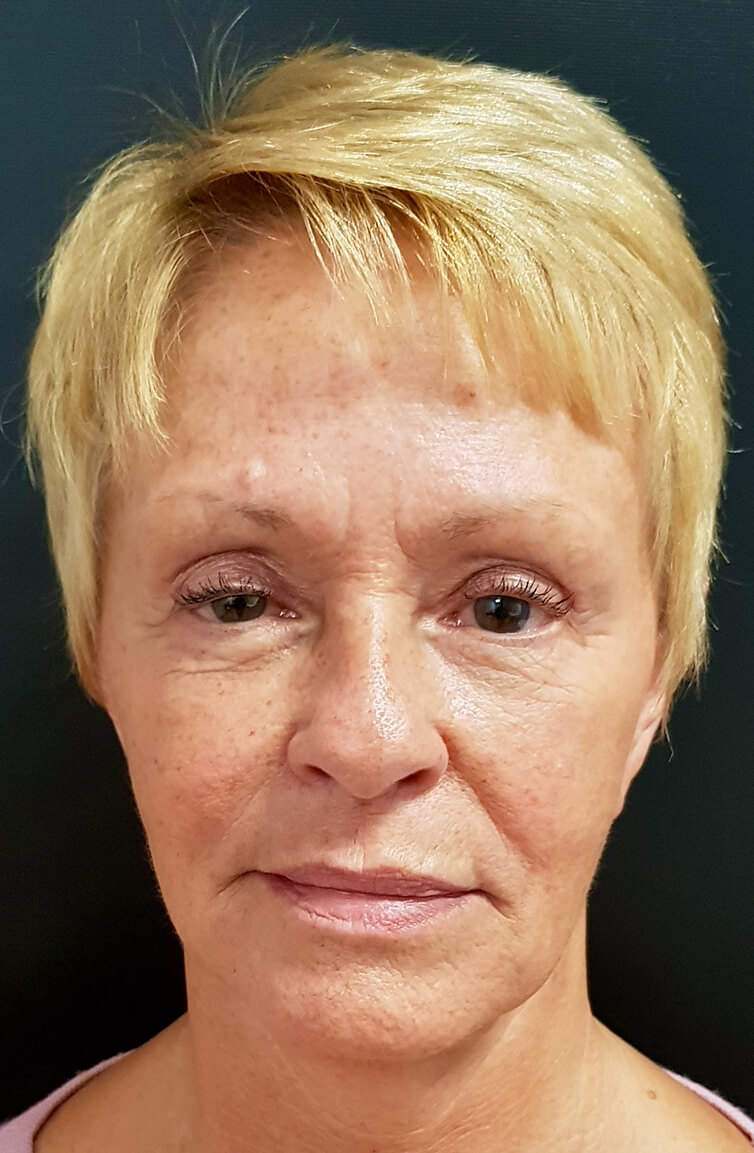 Chin Reduction Pre-op