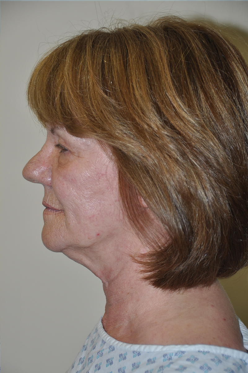 Facelift Pre-op