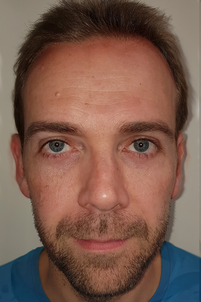 Otoplasty Post-op