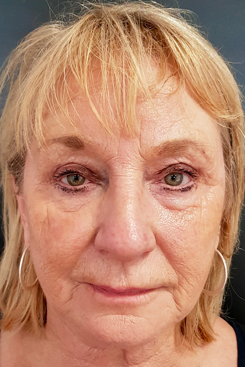 Facelist Pre-op